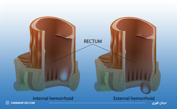هموروئید ترومبوزه و دلایل ایجاد آن
