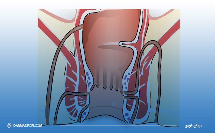 انواع آبسه مقعدی