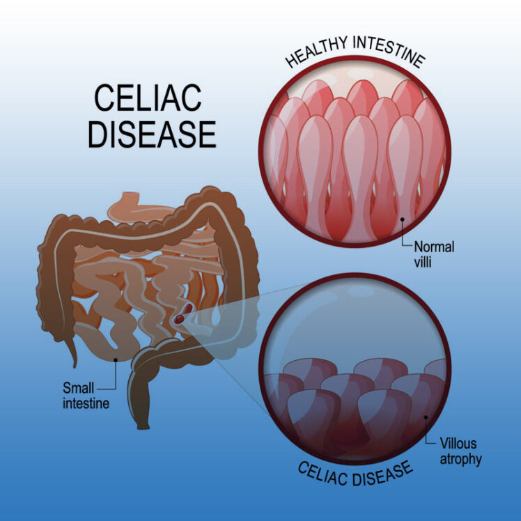 علائم بیماری سلیاک چیست و چگونه تشخیص داده می‌شود؟