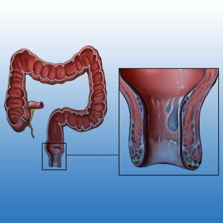 بواسیر (هموروئید) خونی چیست و چگونه درمان می‌شود؟