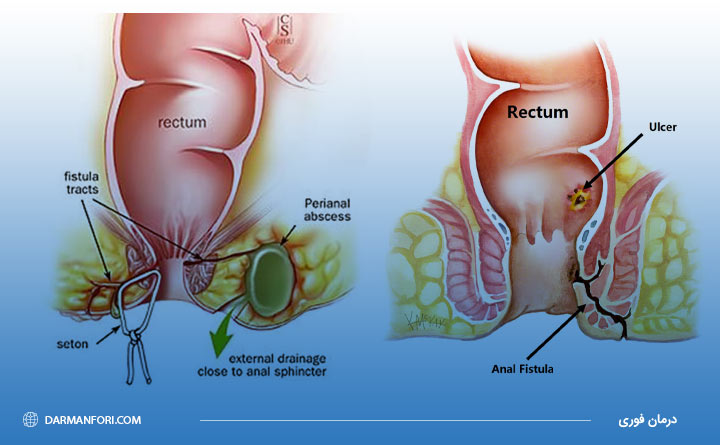 آشنایی با تفاوت آبسه مقعدی و فیستول مقعد