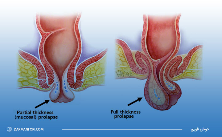 آشنایی با بیرون زدگی مقعد یا پرولاپس رکتوم