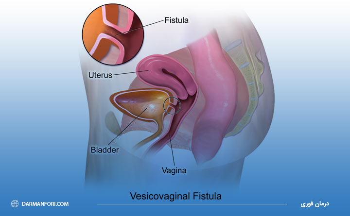 آشنایی با فیستول مقعدی
