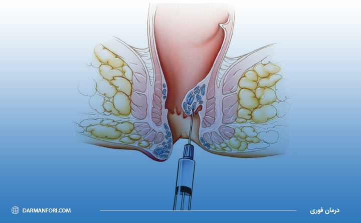 برداشتن هموروئید 