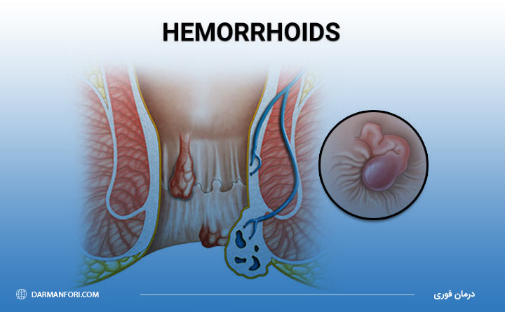 بواسیر یا هموروئید و بوی بد مقعد