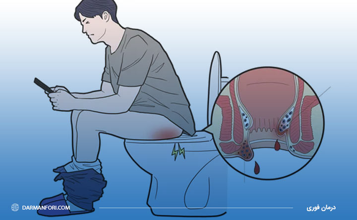 نشانه‌های بواسیر در مردان 