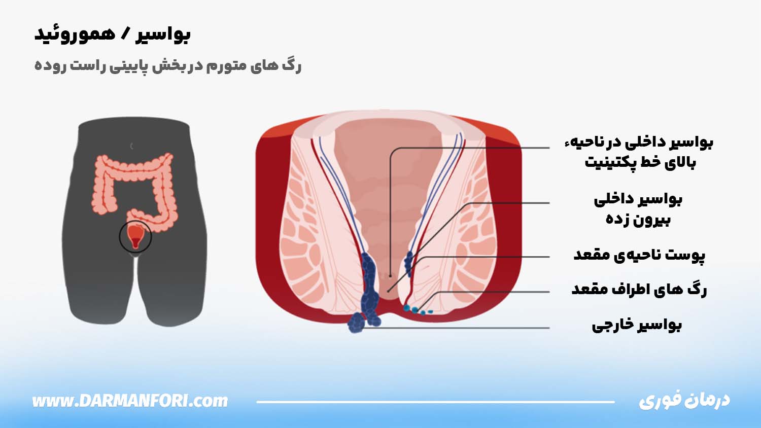 انواع بواسیر ناشی از سکس مقعدی