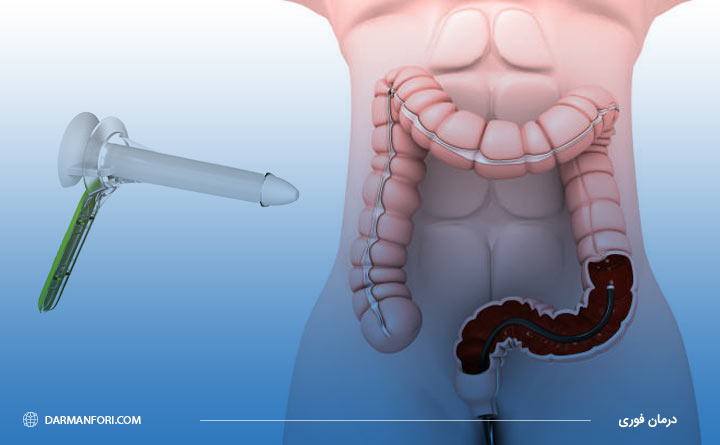  آشنایی با تفاوت آنوسکوپی و کولونوسکوپی