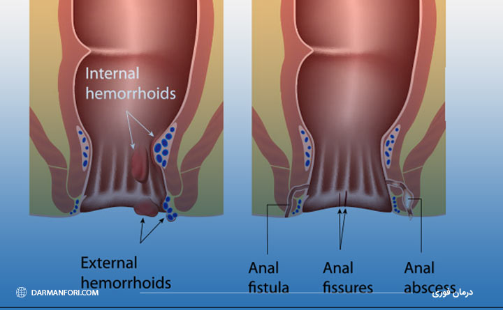 یکسان بودن بیماری شقاق فیستول،هموروئید