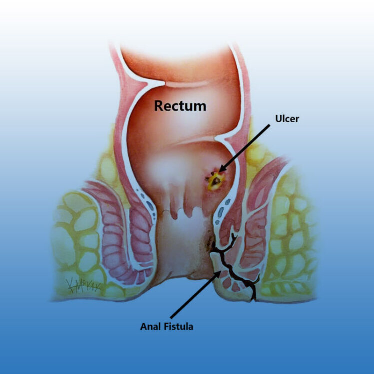 روش‌های جراحی فیستول مقعد