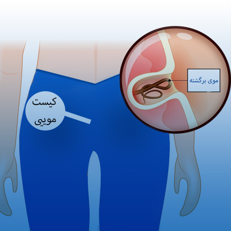 علائم کیست مویی مقعدی چیست؟