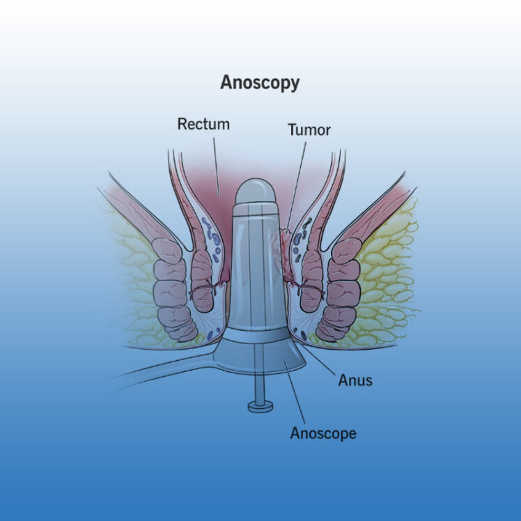 کاربرد معاینه مقعدی یا Anoscopy چیست و چگونه انجام می‌شود؟