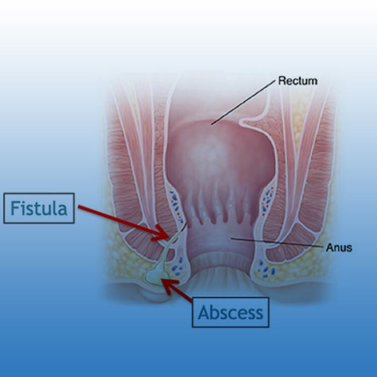 تفاوت آبسه مقعدی و فیستول مقعد و روش‌های تشخیص این دو بیماری