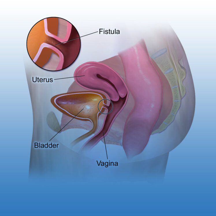 علائم و درمان فیستول در زنان