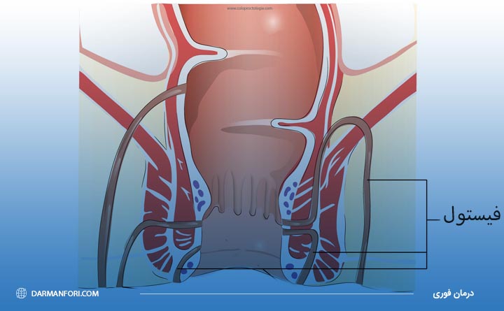 علائم فیستول مقعدی در آقایان