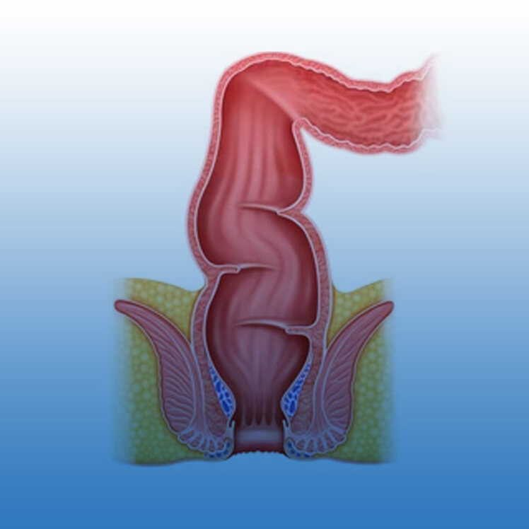 درمان گشادی مقعد، علائم و دلایل + عکس گشاد شدن مقعد