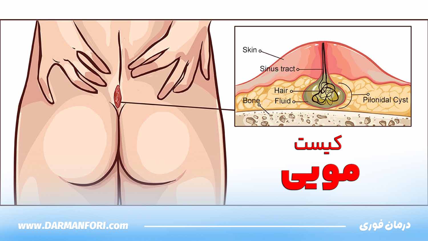 عوارض کیست مویی