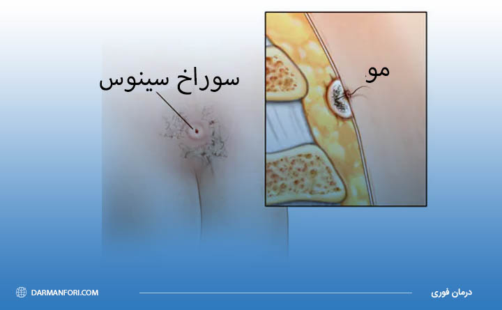 کیست مویی چیست