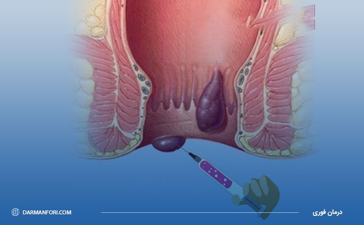درمان بواسیر بدون جراحی 