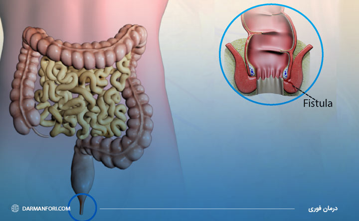 فیستول مقعدی درمان نشده