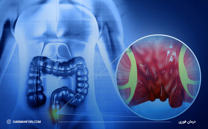 مشکلاتی که بیماری بواسیر در بدن ایجاد می کند