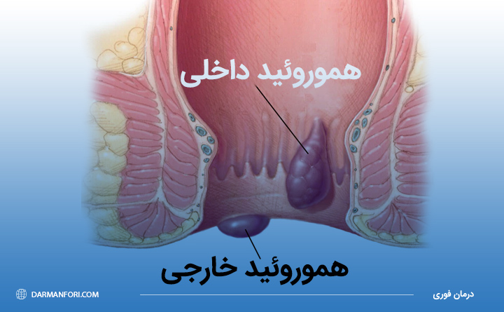 بیماری بواسیر چیست؟