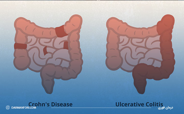 انواع بیماری کرون