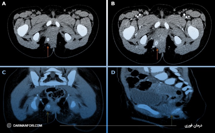 انجام MRI برای تشخیص آبسه مقعدی در کودکان