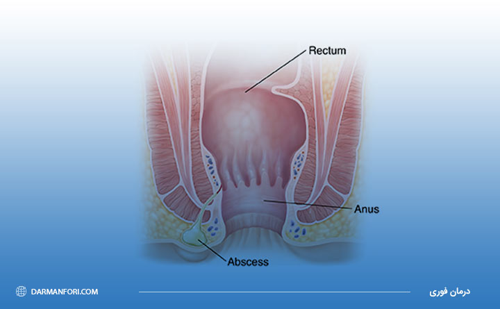 بیماری آبسه مقعدی