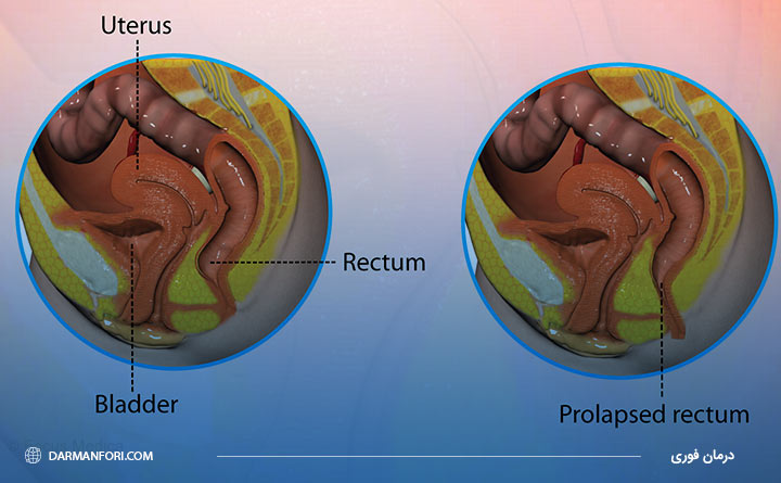 پرولاپس رکتوم