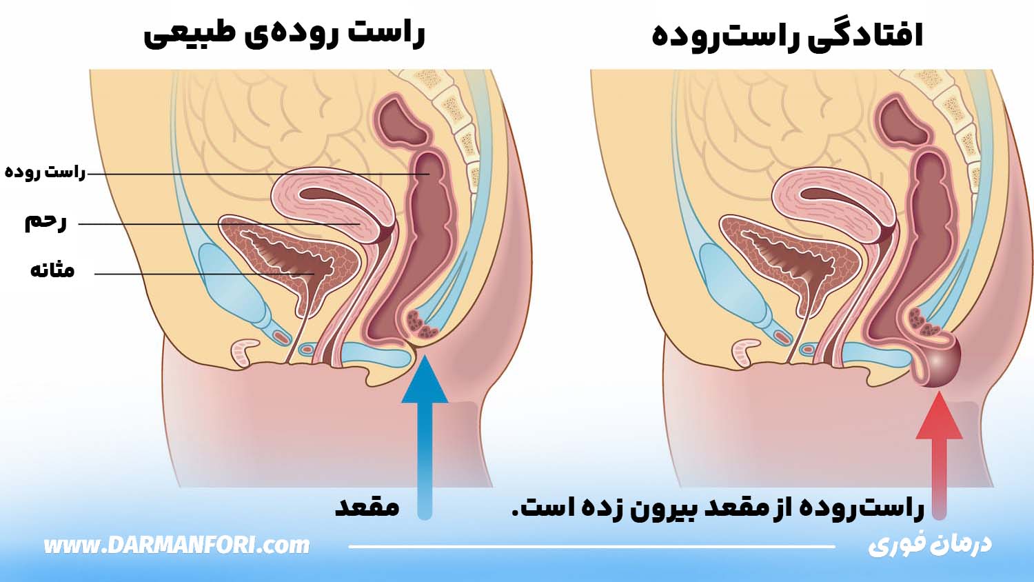 بیرون زدگی مقعد در اثر سکس مقعدی