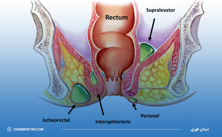 آشنایی با انواع آبسه مقعدی