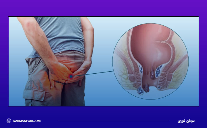 تعریف بیماری هموروئید 