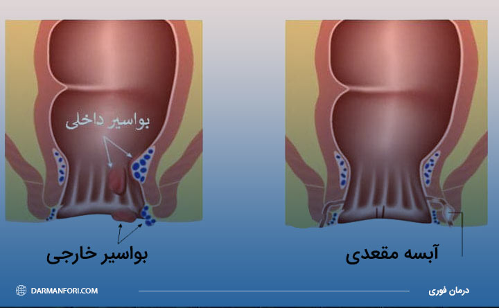 تفاوت آبسه مقعدی و بواسیر 