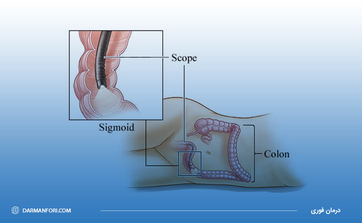 تفاوت آزمایش سیگموئیدوسکوپی با پروکتوسکوپی