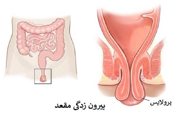 بیرون زدگی مقعدی، چگونه یک دکتر بواسیر خوب در تهران پیدا کنیم؟