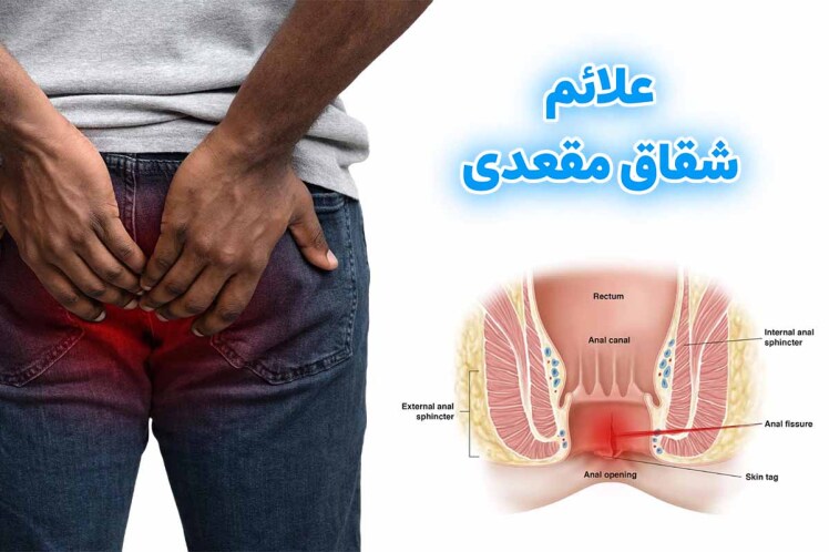 علائم شقاق مقعدی چیست؟ نشانهها، تشخیص سریع + راههای پیشگیری از بیماری