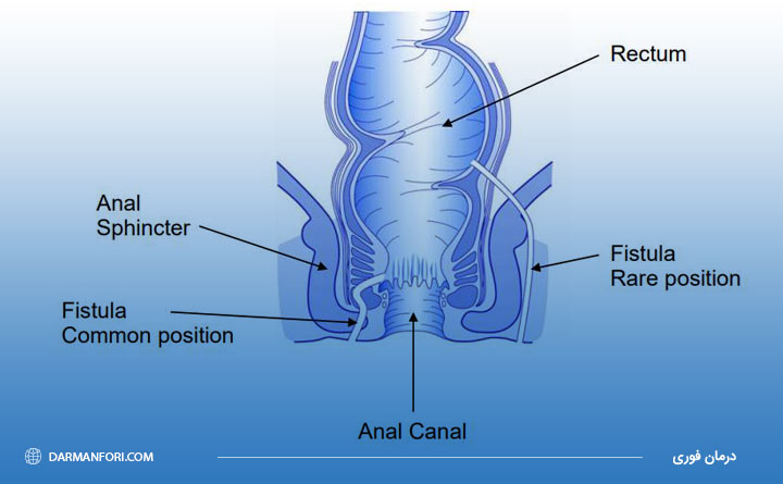 بیماری فیستول مقعدی