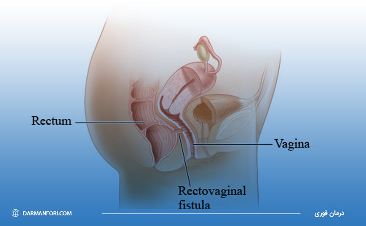 فیستول رکتوواژینال