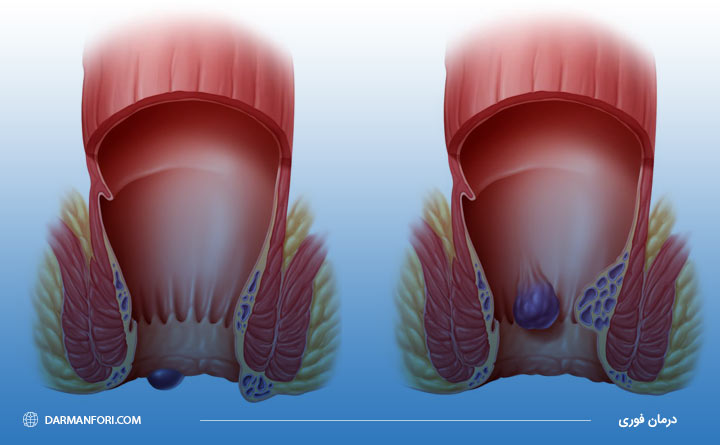 بیماری بواسیر چیست؟