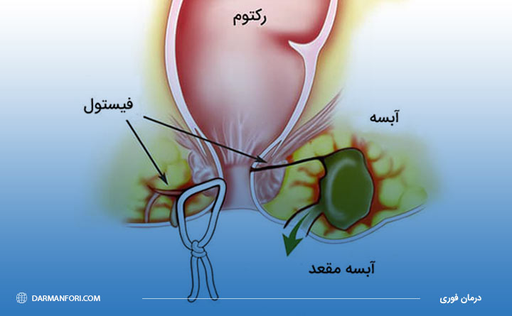 آشنایی با آبسه مقعدی