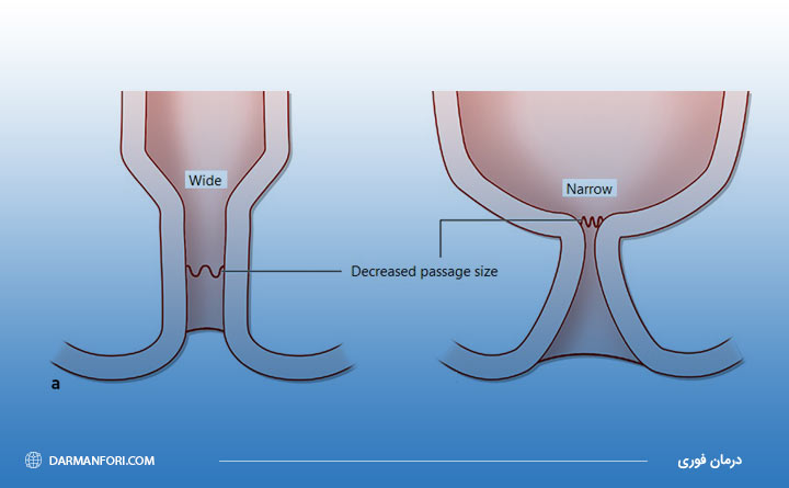 آشنایی با بیماری تنگی مقعد