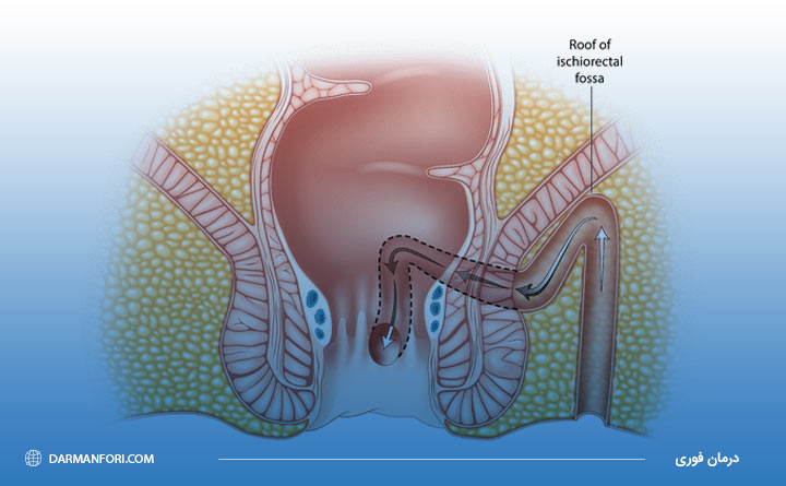 تکنیک فیستولوتومی برای جراحی فیستول مقعدی