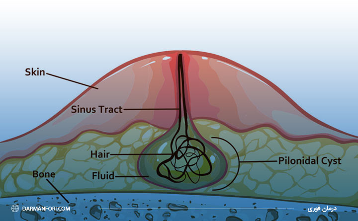 آشنایی با سینوس پیلونیدال کیست مویی 