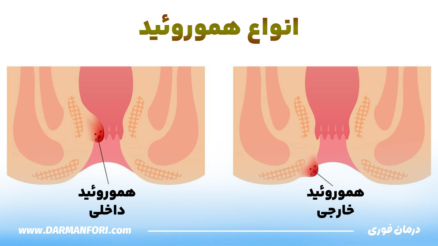 تفاوت بواسیر داخلی و خارجی