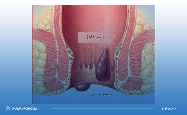 انواع مختلف بواسیر