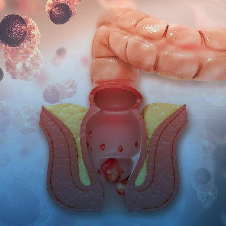 بواسیر داخلی چیست؟ و درمان آن
