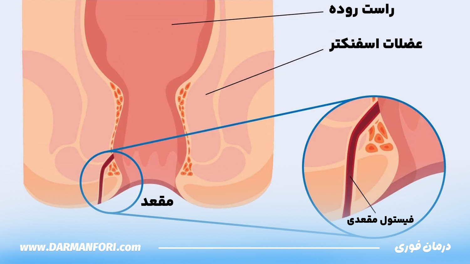 تصویر شماتیک فیستول مقعدی و مسیر ارتباطی بین روده و پوست