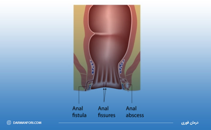بیماری فیستول مقعد و بوی بد مقعد