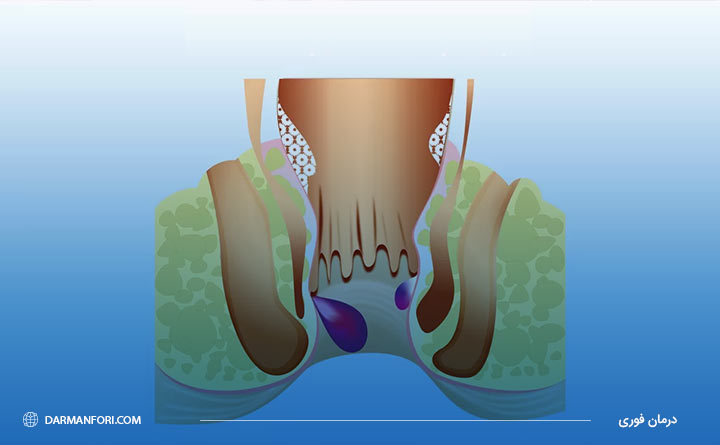درمان بواسیر